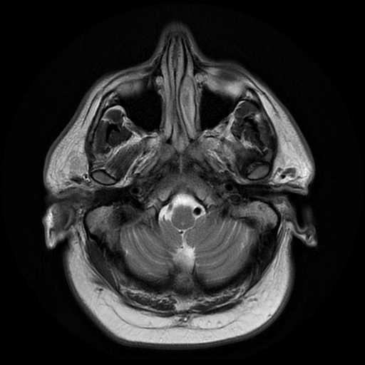 File:Colloid cyst with anterior communicating artery aneurysm (Radiopaedia 33901-35091 Axial T2 3).jpg