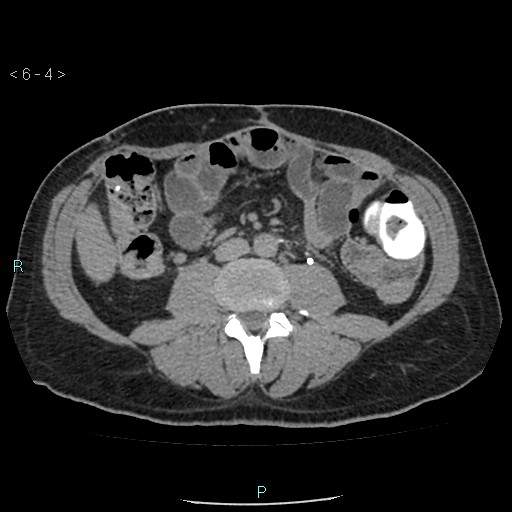 File:Colo-cutaneous fistula (Radiopaedia 40531-43129 A 1).jpg