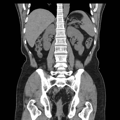 File:Colocutaneous fistula in Crohn's disease (Radiopaedia 29586-30093 Coronal non-contrast 28).jpg