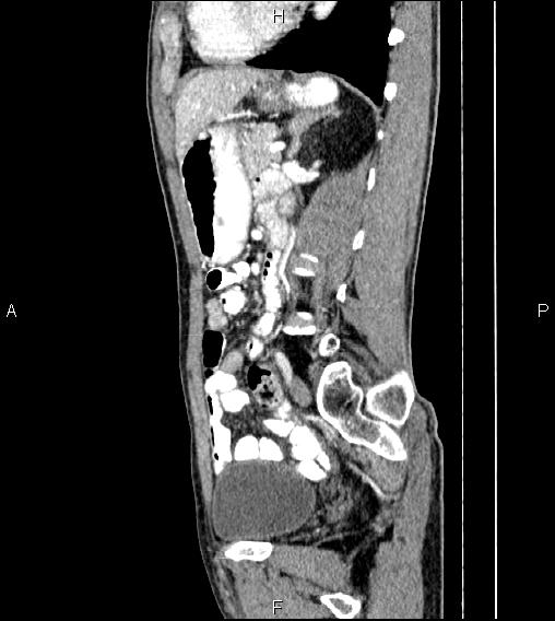 Colon adenocarcinoma - hepatic flexure (Radiopaedia 85635-101395 D 56).jpg