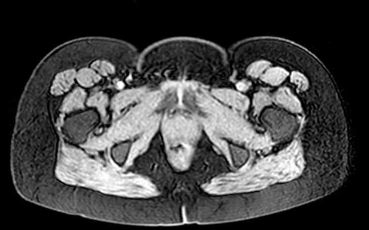 Colon adenocarcinoma with Krukenberg tumors, advanced pregnancy (Radiopaedia 67279-76645 A 5).jpg