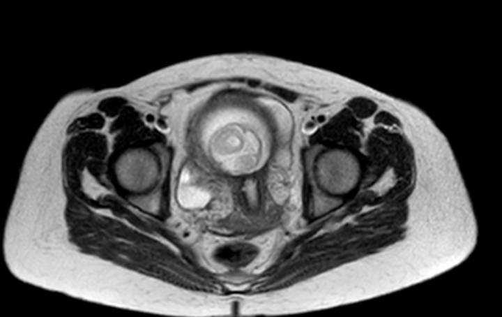 Colon adenocarcinoma with Krukenberg tumors, advanced pregnancy (Radiopaedia 67279-76645 Axial T2 10).jpg