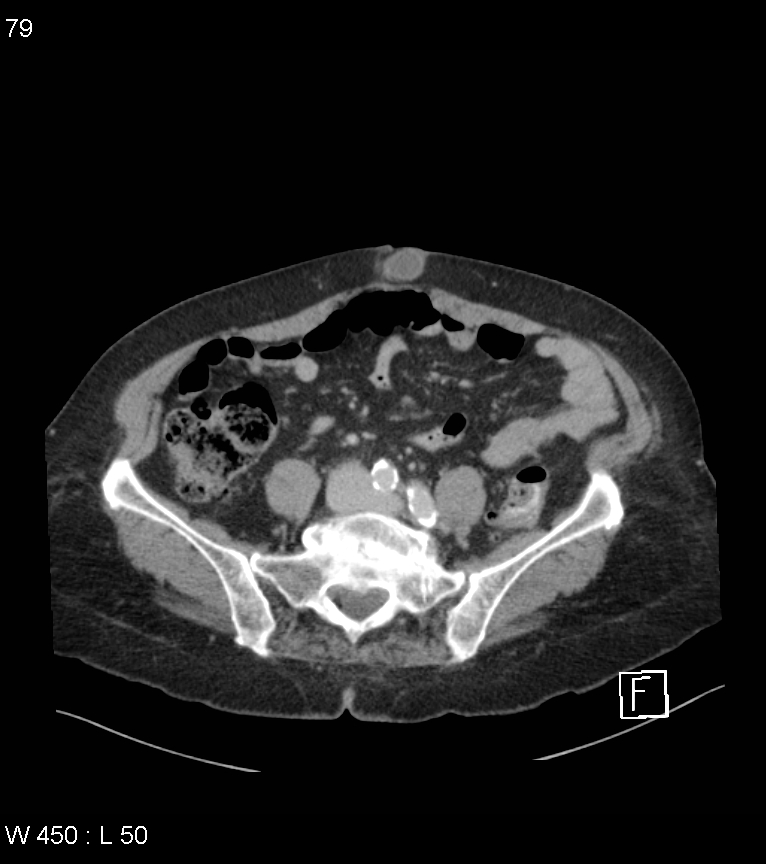 Colonic diverticular hemorrhage (Radiopaedia 52561-58475 C 72).jpg