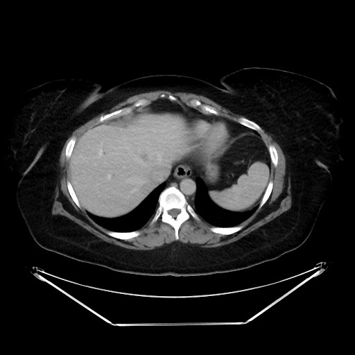 File:Colonic intussusception due to adenocarcinoma (Radiopaedia 86828-102987 A 25).jpg