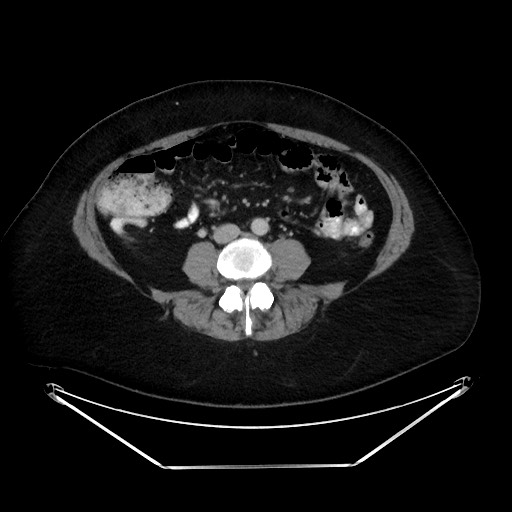 File:Colonic intussusception due to adenocarcinoma (Radiopaedia 86828-102987 Axial 4).jpg