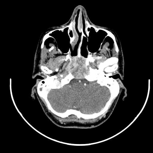 Nasopharyngeal carcinoma - infiltrating the clivus (Radiopaedia 62583-70875 Axial Post contrast 13).jpg