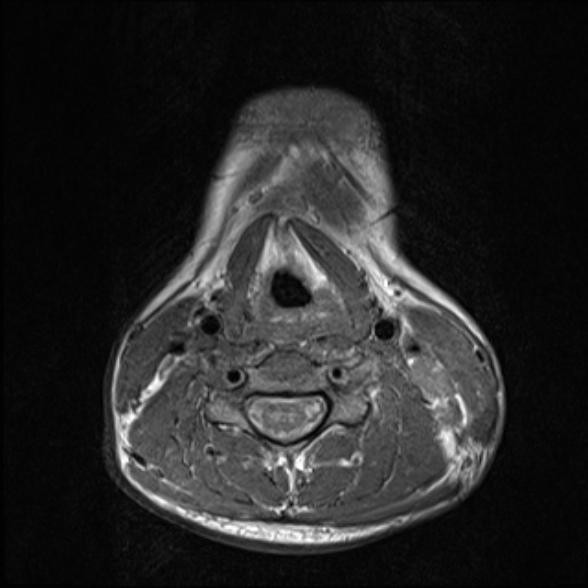 Nasopharyngeal carcinoma with skull base invasion (Radiopaedia 53415-59485 Axial T1 55).jpg