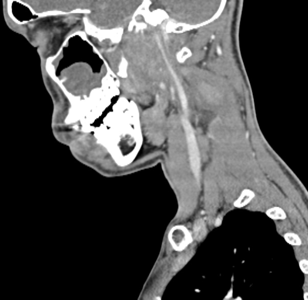 File:Nasopharyngeal carcinoma with skull base invasion (Radiopaedia 53415-59705 C 51).jpg