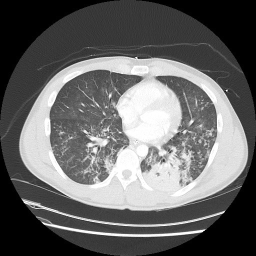 Near-drowning pulmonary edema (Radiopaedia 59457-66814 Axial lung window 36).jpg