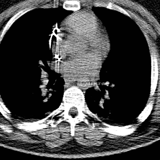 File:Neck CT angiogram (intraosseous vascular access) (Radiopaedia 55481-61945 Axial Monitoring 6).jpg