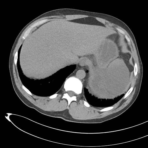 File:Necrotizing pancreatitis with acute necrotic collections (Radiopaedia 38829-41012 Axial non-contrast 15).png