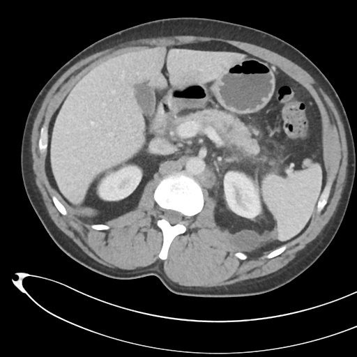 File:Necrotizing pancreatitis with acute necrotic collections (Radiopaedia 38829-41012 B 29).png