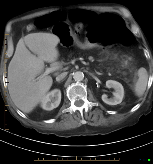 Necrotzing fasciitis due to a perforated adenocarcinoma of the splenic flexure (Radiopaedia 46930-51455 A 25).jpg