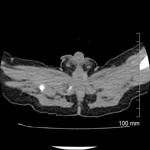 File:Neonatal neuroblastoma (Radiopaedia 56651-63438 Axial non-contrast 87).jpg