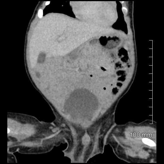 File:Neonatal neuroblastoma (Radiopaedia 56651-63438 Coronal non-contrast 16).jpg
