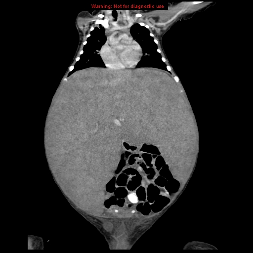 File:Neonatal neuroblastoma (Radiopaedia 9564-10223 B 56).jpg