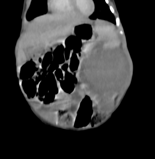 Nephroblastomatosis (Radiopaedia 71294-81607 B 102).jpg