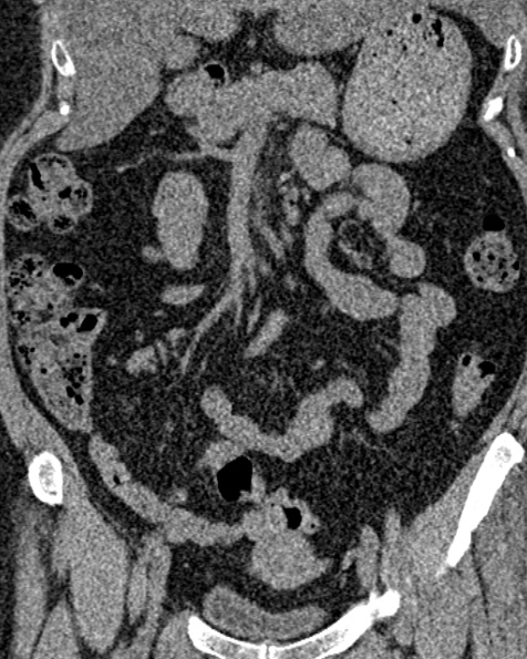 File:Nephrostomy for urosepsis (Radiopaedia 26180-26330 non-contrast 38).jpg