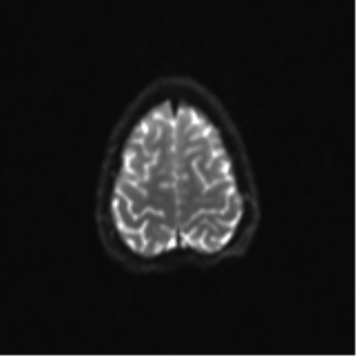 Neurenteric cyst (Radiopaedia 58641-65837 Axial DWI 31).png