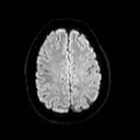 File:Neuro-Behcet's disease (Radiopaedia 21557-21506 Axial DWI 20).jpg