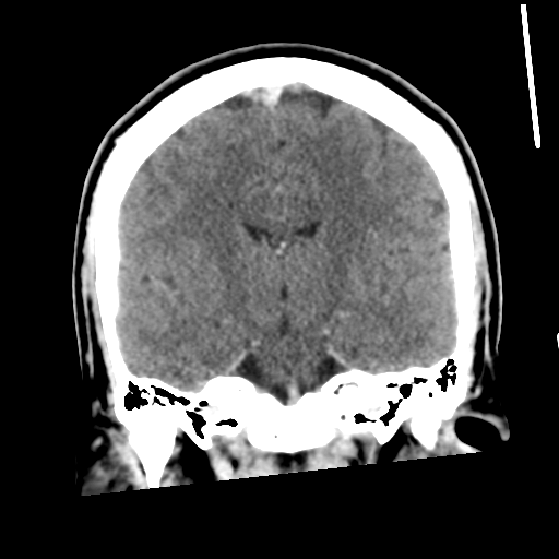 Neurocysticercosis - granular nodular (Radiopaedia 42786-45957 Coronal C+ 35).png