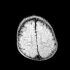 File:Neurofibromatosis type 1 (Radiopaedia 30089-30671 Axial FLAIR 19).jpg