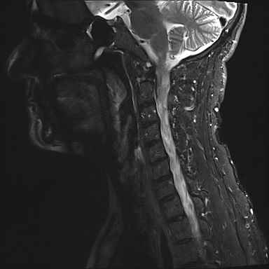 File:Neurofibromatosis type 1 (Radiopaedia 80355-93740 Sagittal STIR 7).jpg