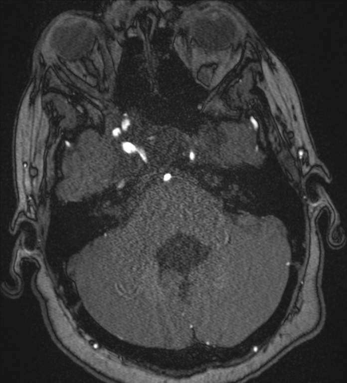 Neurofibromatosis type 1 - head and neck - CNS manifestations (Radiopaedia 49910-55188 Axial MRA 16).png