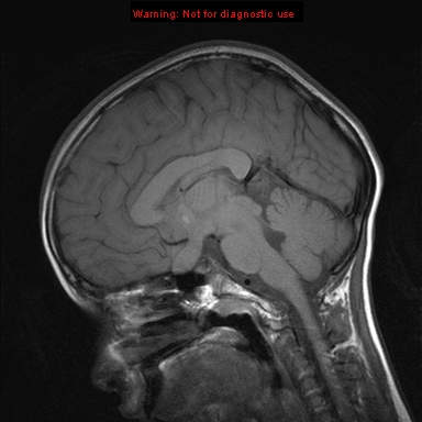 File:Neurofibromatosis type 1 with optic nerve glioma (Radiopaedia 16288-15965 Sagittal T1 13).jpg