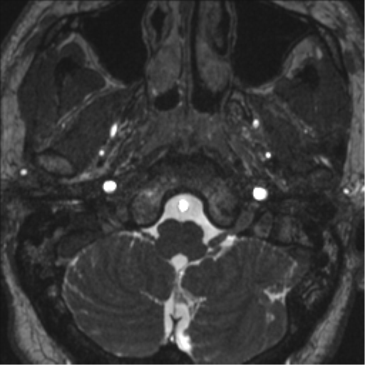 Neurofibromatosis type 2 (Radiopaedia 44936-48838 E 8).png