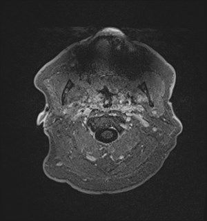 Neurofibromatosis type 2 (Radiopaedia 79097-92049 Axial T1 C+ 5).jpg