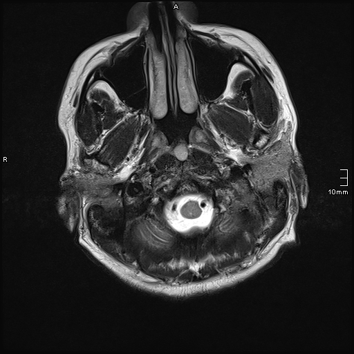 File:Neurotoxoplasmosis - concentric target sign (Radiopaedia 70644-80784 Axial T2 2).jpg