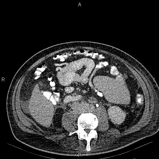 Non Hodgkin lymphoma in a patient with ankylosing spondylitis (Radiopaedia 84323-99621 Axial C+ delayed 41).jpg