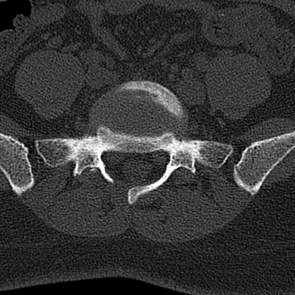 File:Normal CT lumbar spine (Radiopaedia 53981-60118 Axial bone window 64).jpg