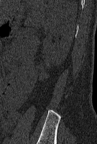 File:Normal CT lumbar spine (Radiopaedia 53981-60118 Sagittal bone window 99).jpg