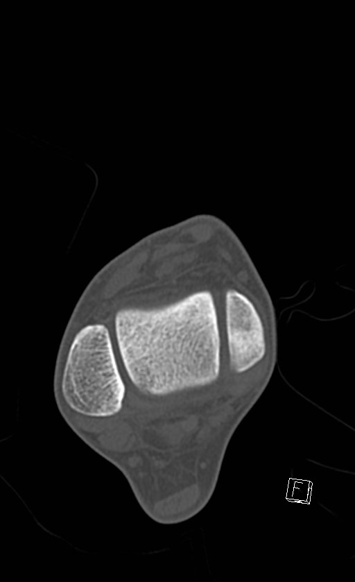 Normal CT of the ankle (Radiopaedia 47111-51658 Axial bone window 41).jpg