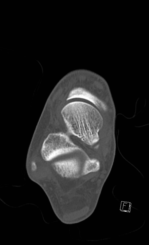 Normal CT of the ankle (Radiopaedia 47111-51658 Axial bone window 55).jpg