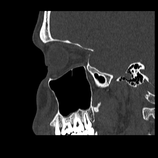 Normal CT paranasal sinuses (Radiopaedia 42286-45390 Sagittal bone window 27).jpg