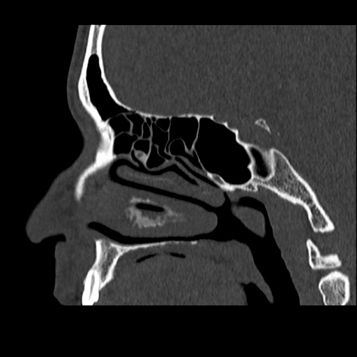 Normal CT paranasal sinuses (Radiopaedia 42286-45390 Sagittal bone window 42).jpg