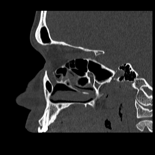 Normal CT paranasal sinuses (Radiopaedia 42286-45390 Sagittal bone window 66).jpg