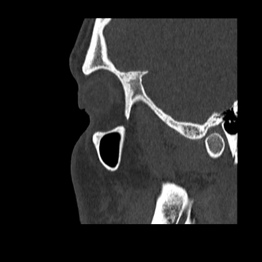 Normal CT paranasal sinuses (Radiopaedia 42286-45390 Sagittal bone window 91).jpg