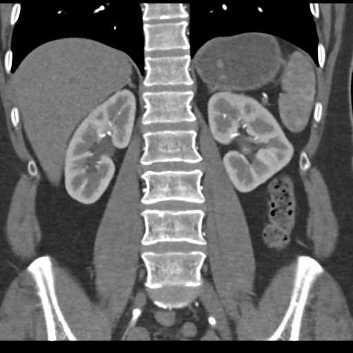 File:Normal CT renal artery angiogram (Radiopaedia 38727-40889 B 50).png