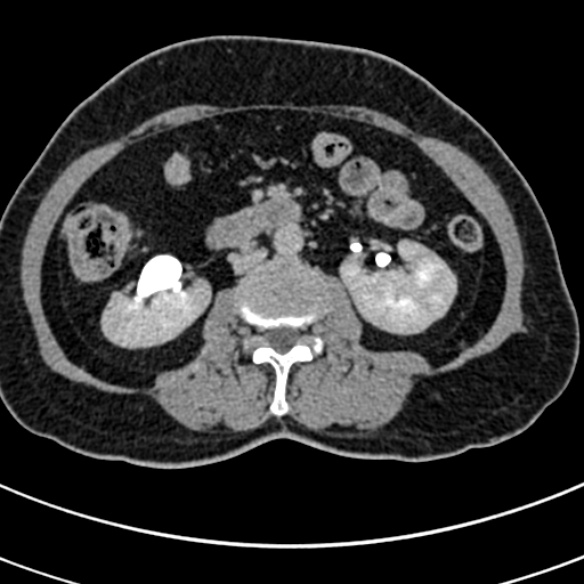 File:Normal CT split bolus study of the renal tract (Radiopaedia 48631-53634 Axial split bolus 108).jpg