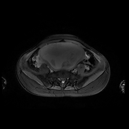 File:Normal MRI abdomen in pregnancy (Radiopaedia 88001-104541 D 40).jpg