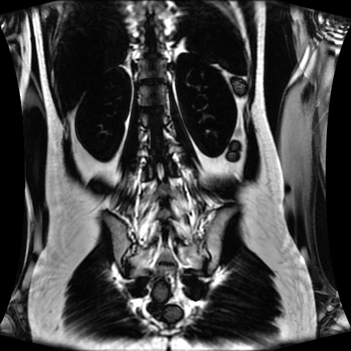 Normal MRI abdomen in pregnancy (Radiopaedia 88001-104541 N 104).jpg