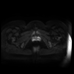 Normal MRI abdomen in pregnancy (Radiopaedia 88005-104548 Axial DWI 43).jpg