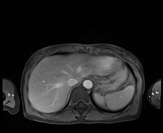 Normal adrenal glands MRI (Radiopaedia 82017-96004 M 16).jpg