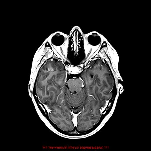 Normal adult brain MRI (non-enhanced and contrast-enhanced) (Radiopaedia 75262-86379 Axial T1 C+ 84).jpg