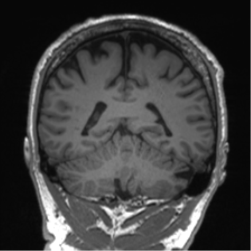 Normal brain MRI (non-focal epilepsy protocol) (Radiopaedia 53917-60040 Coronal T1 24).png