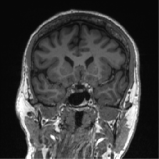 Normal brain MRI (non-focal epilepsy protocol) (Radiopaedia 53917-60040 Coronal T1 44).png